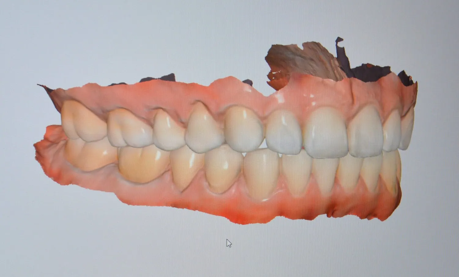 3D digital model of upper and lower human teeth showing alignment and gums.