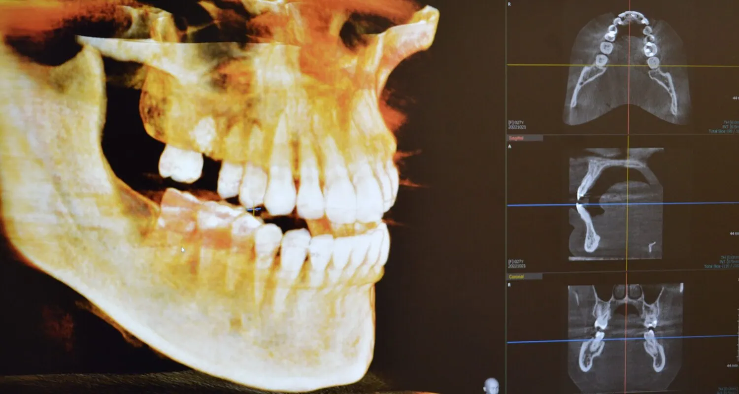 3D dental X-ray showing side view of skull and detailed scans of upper jaw, lower jaw, and teeth.