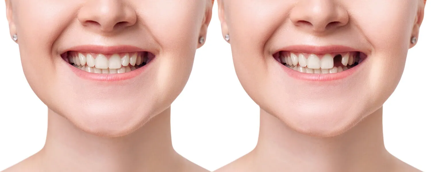 Side-by-side comparison of a woman's smile showing healthy teeth on the left and a missing tooth on the right.