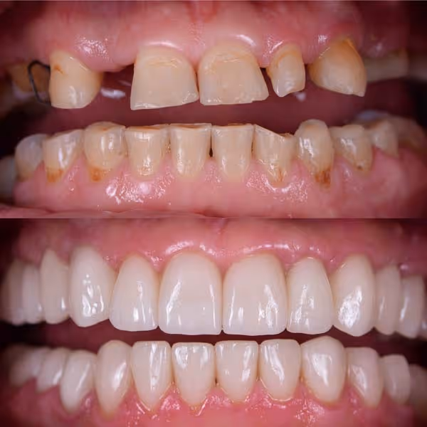 Before and after dental restoration showing damaged teeth replaced by white, even teeth.