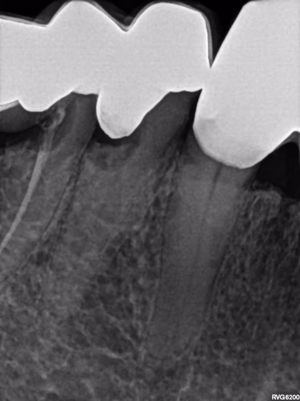 Dental X-ray showing three teeth with root canal treatments and visible supporting bone structure.