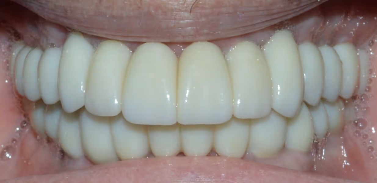 Close-up of a full set of white dental implants in a smiling mouth.