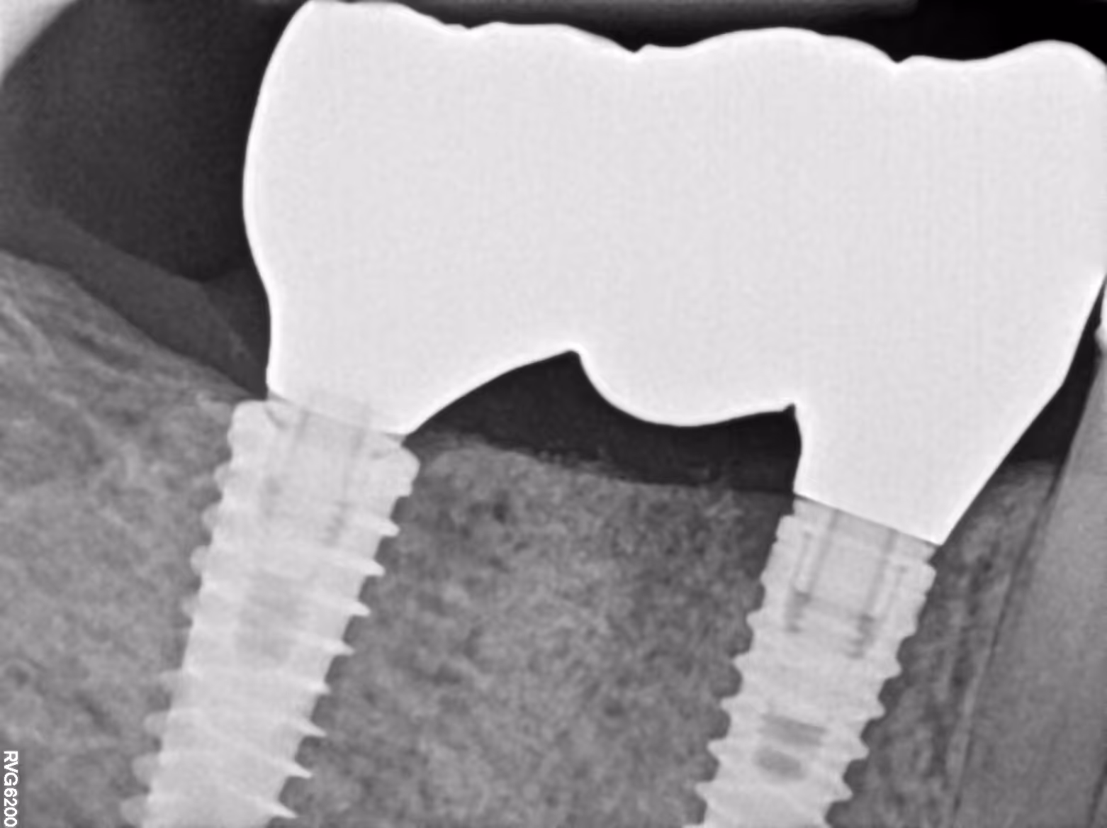 Dental X-ray showing two dental implants supporting a fixed dental bridge in the jawbone.