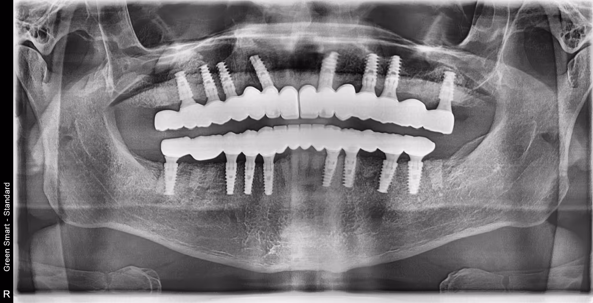 Panoramic dental X-ray showing both jaws with multiple dental implants and prosthetic teeth.