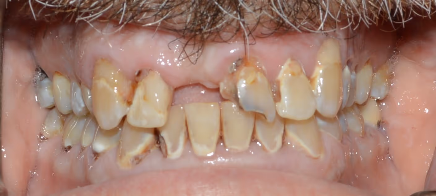 Close-up of a mouth with severely decayed, discolored, and missing upper front teeth.