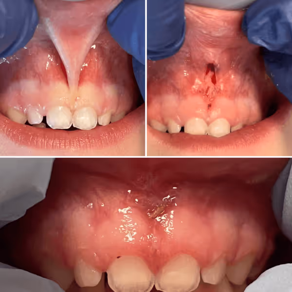 Frenectomy (Labial Tie) in Brooklyn, NY