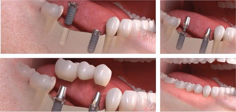 replace multiple teeth implants with implant supported bridge nyc