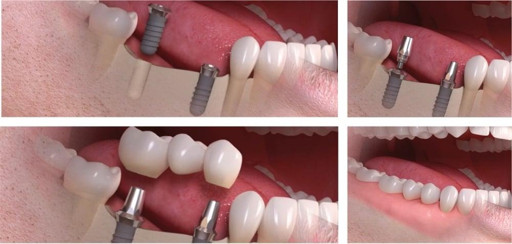 replace multiple teeth implants with implant supported bridge nyc