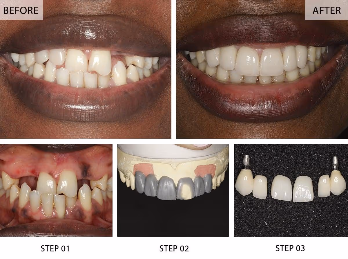 multiple dental implants Cases Before and After Pictures (Case 1)