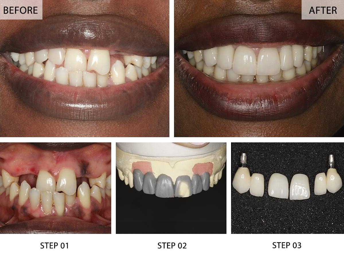 multiple dental implants Cases Before and After Pictures (Case 1)