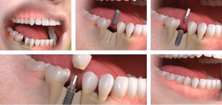 Single tooth implant