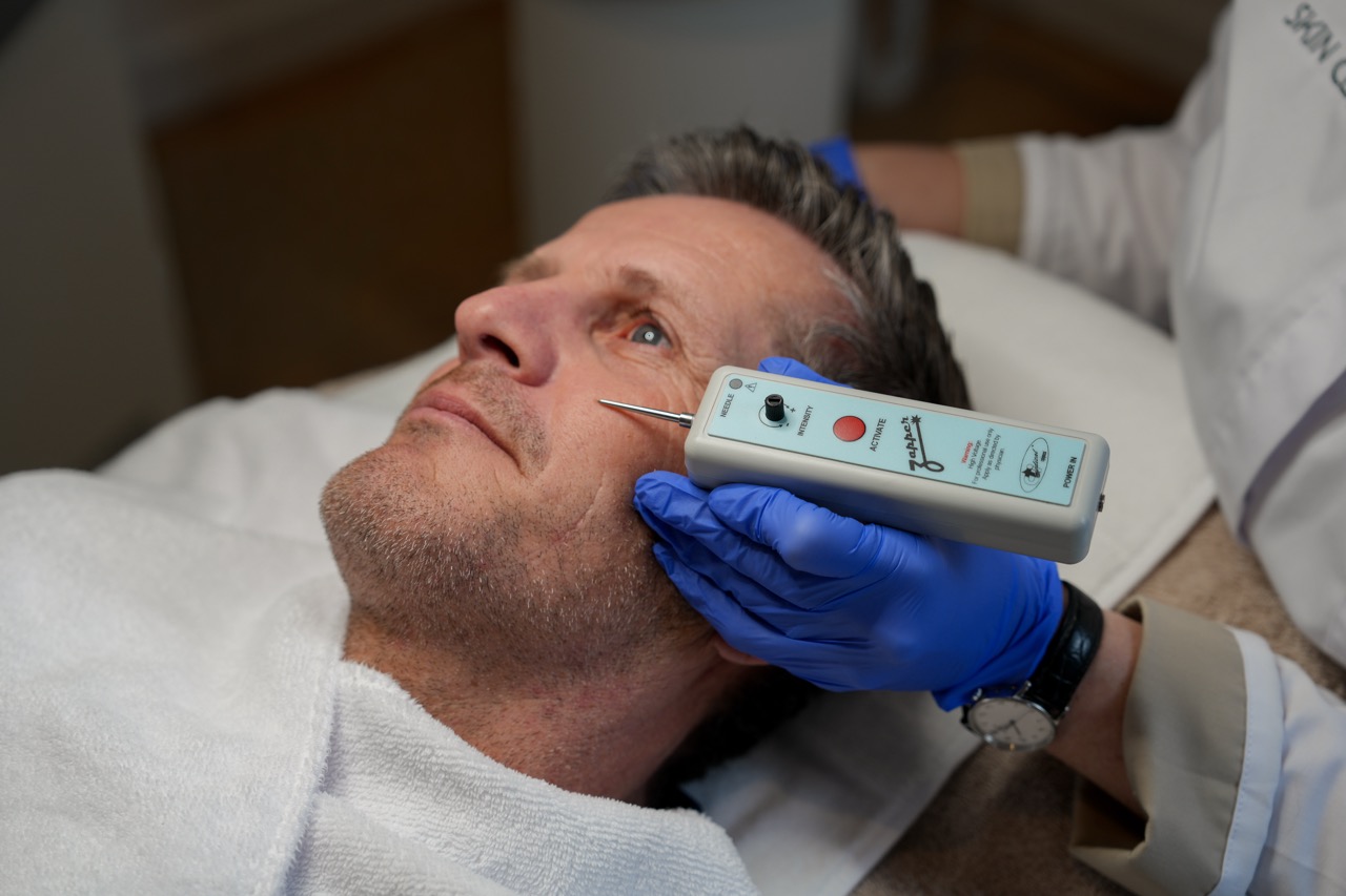 huidoneffenheden verwijderen Grave