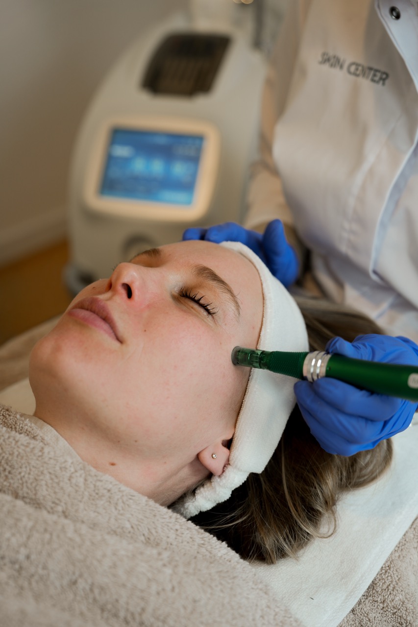 microneedling tegen een doffe huid