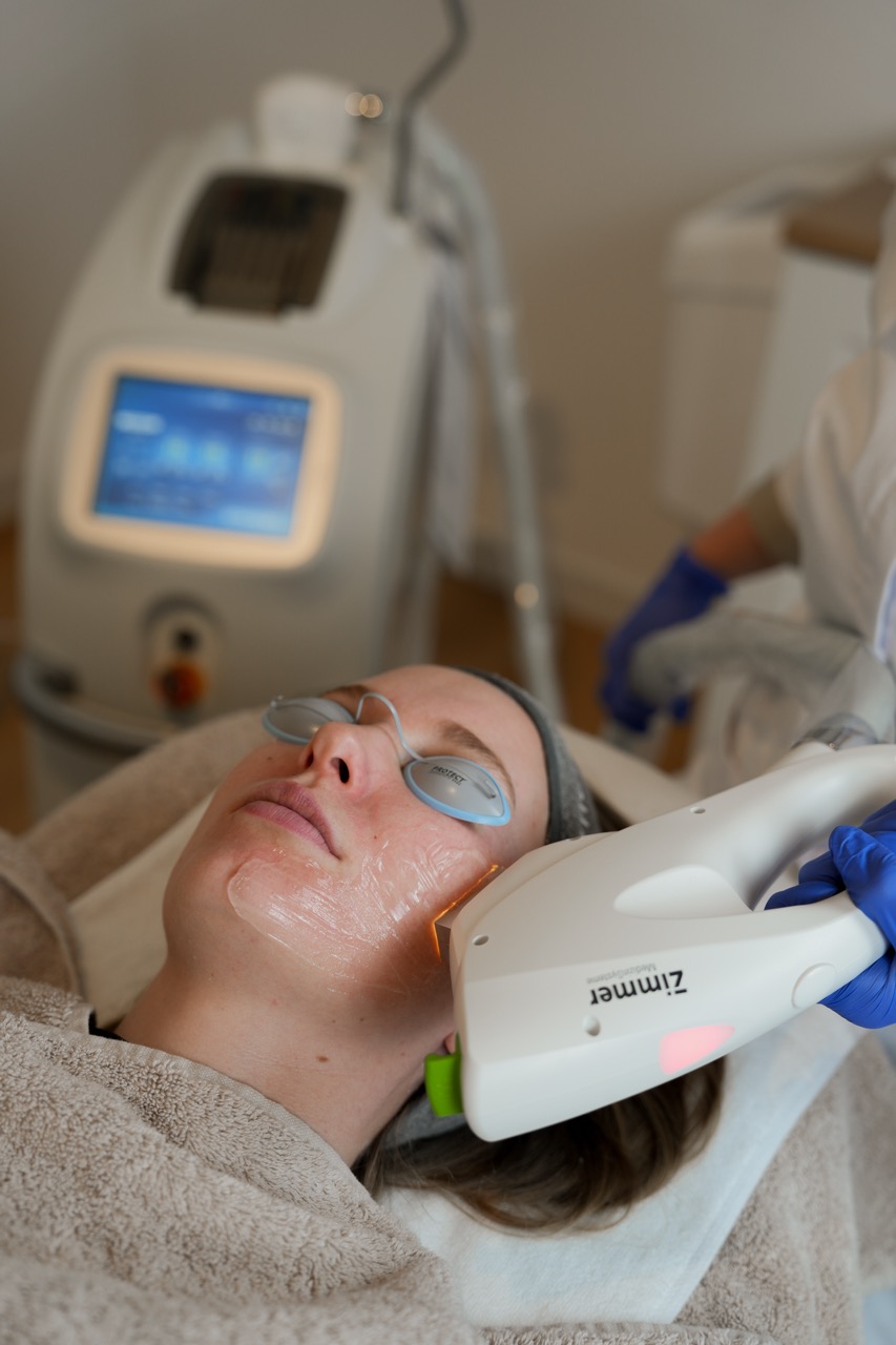 roodheid behandelen met de IPL