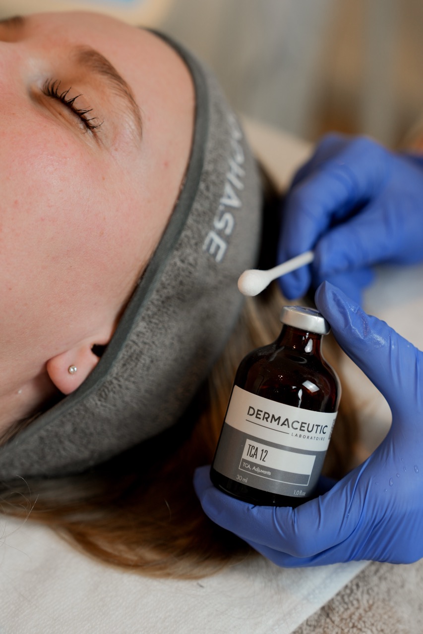 tca peeling aanbrengen