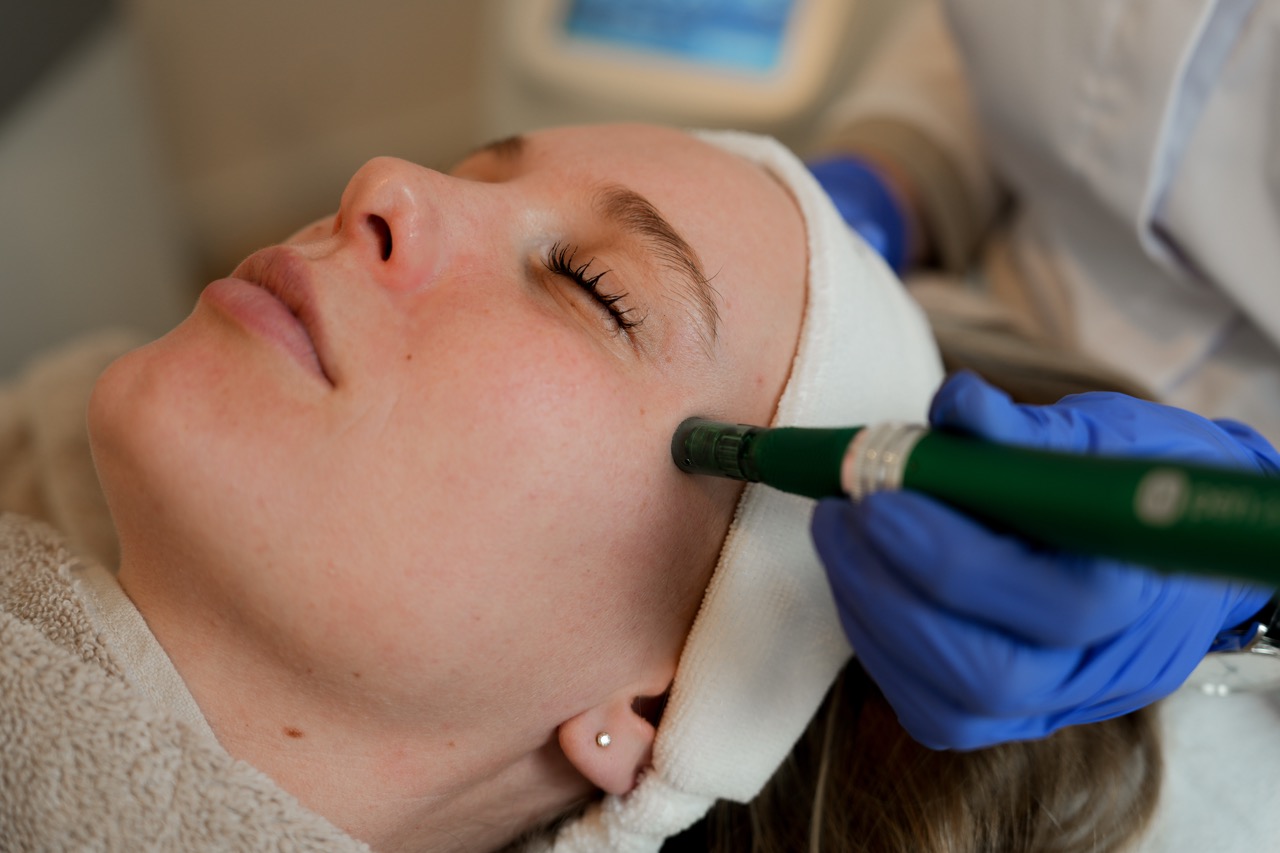 microneedling gezicht