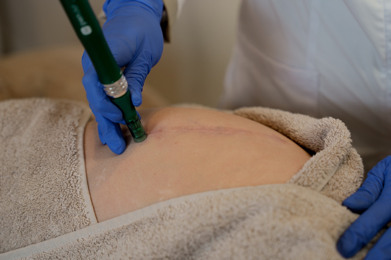 litteken behandelen met microneedling