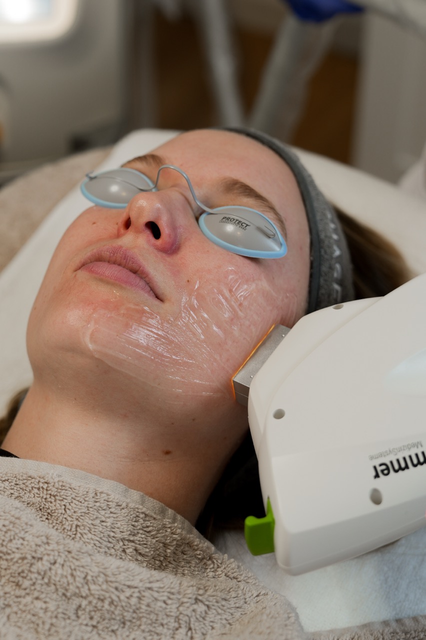 vaatjes behandelen met de vaatlaser