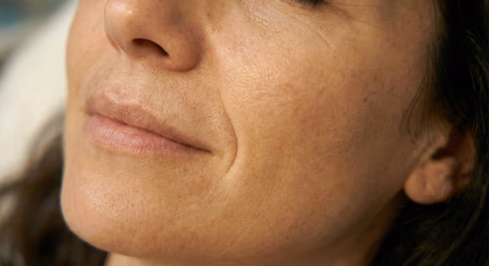 Unterspritzung der Nasolabialfalte zwischen Nase und Mundwinkel zur optischen Verjüngung.