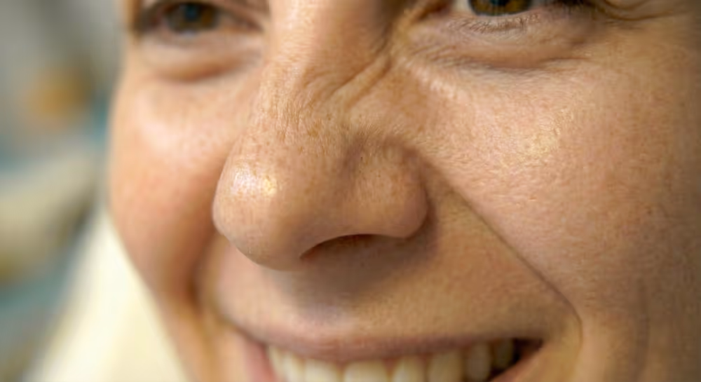 Nahaufnahme des Nasenrückens mit sichtbaren Häschenfalten (Bunny Lines), die beim Naserümpfen entstehen