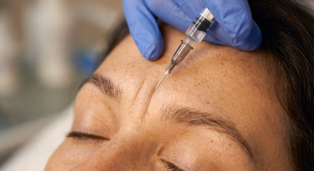 Gezielte Injektion zwischen die Augenbrauen zur Glättung der Zornesfalte