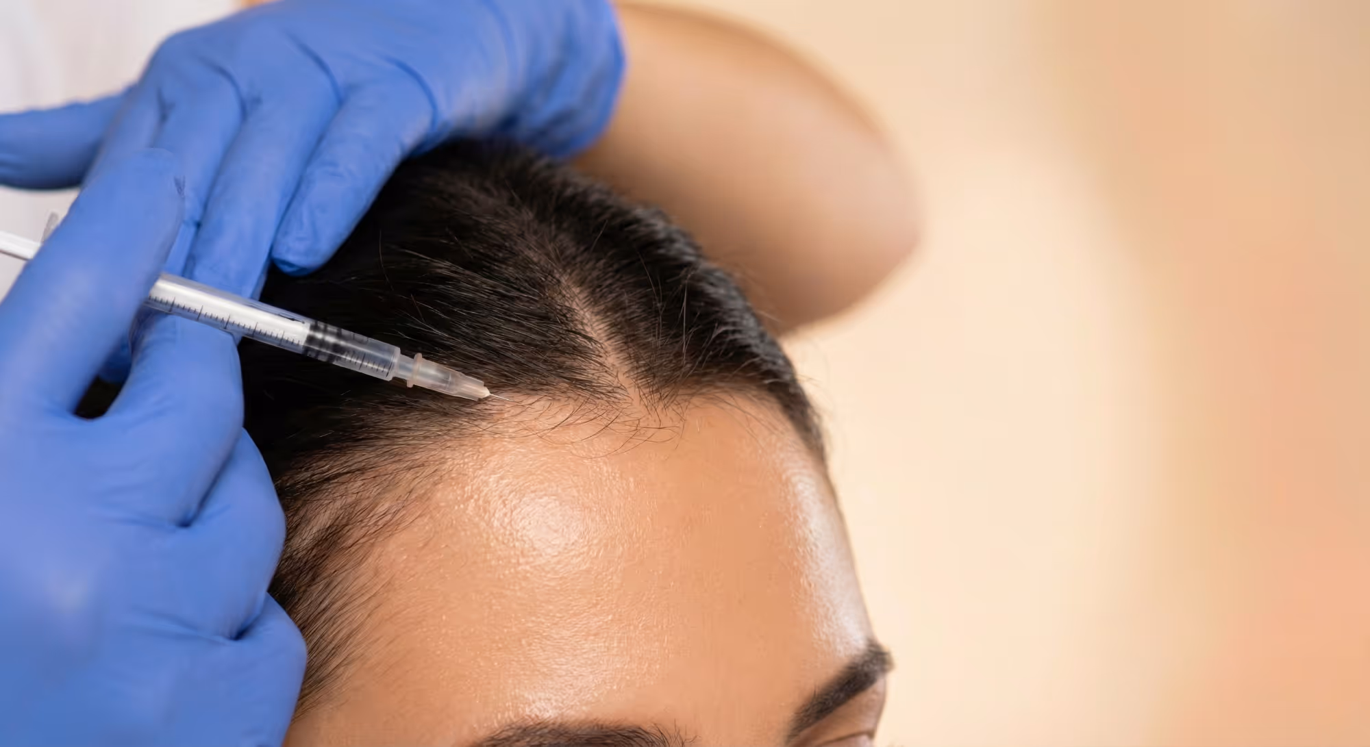 Nahaufnahme von Injektionen in die Kopfhaut zur Haarwiederherstellung und Follikelstimulation.