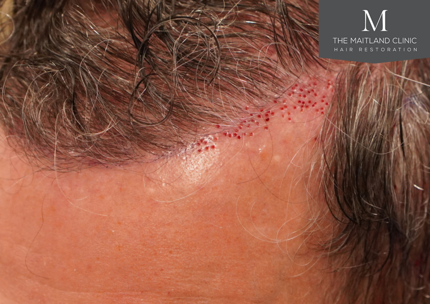 Close-up image of a person's scalp showing small dots from a recent hair restoration procedure.