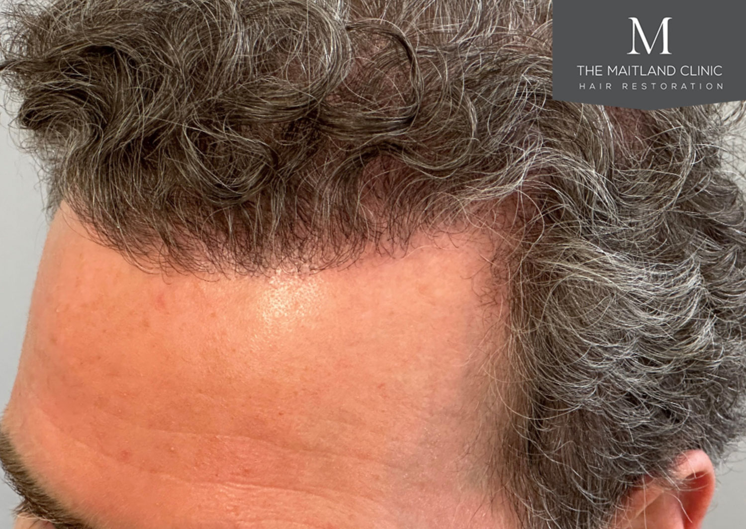 Close-up of a man's head showing a hairline after hair restoration treatment.