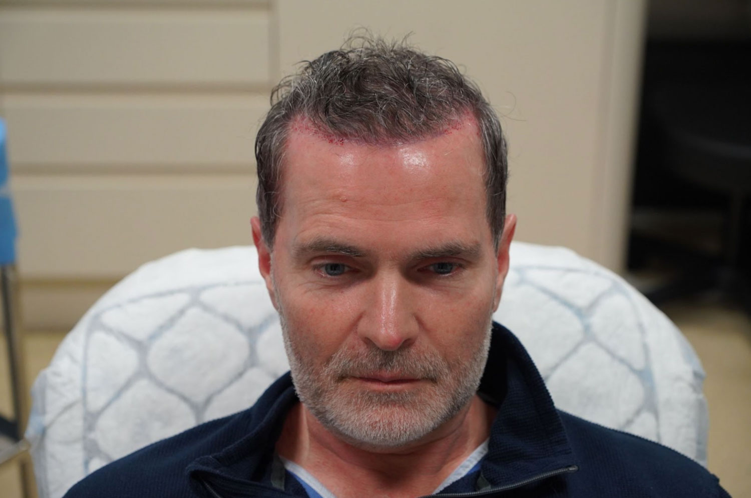 Man with graying beard sits, showing recent hair transplant on his scalp.