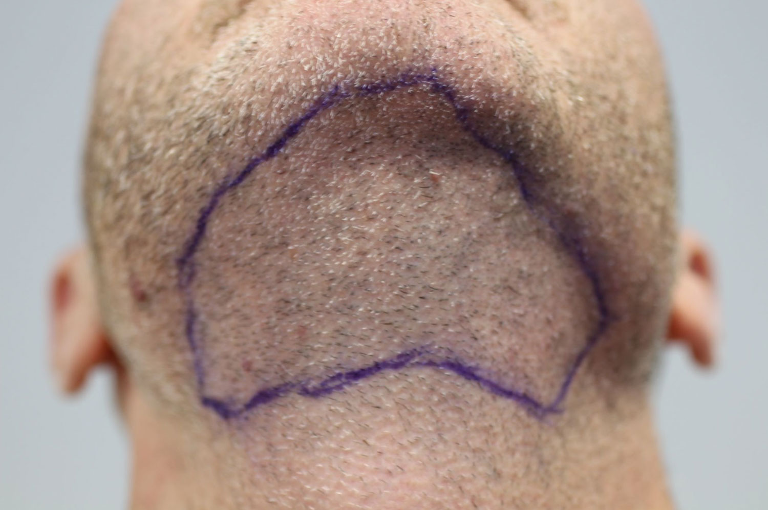 A person's neck with a drawn outline, possibly marking an area for a medical or cosmetic procedure.