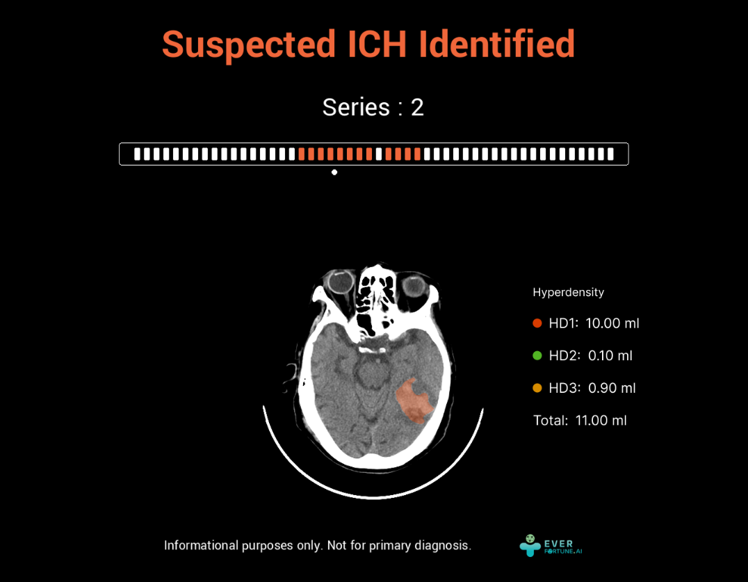 ICH
