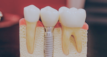 A high success root canal therapy