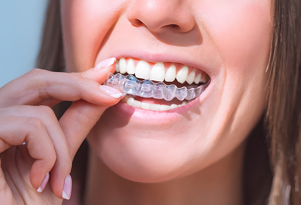 Discreet clear aligners in Hialeah 