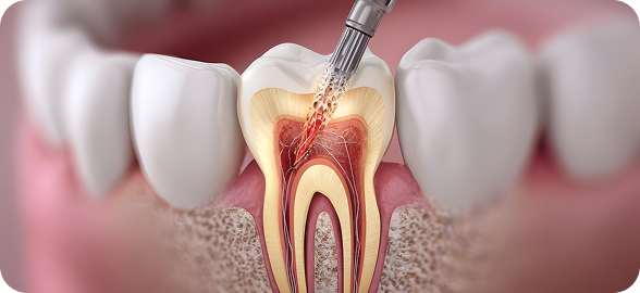 A high success root canal therapy