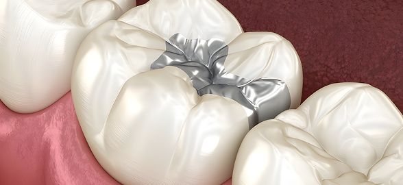 A durable tooth colored fillings