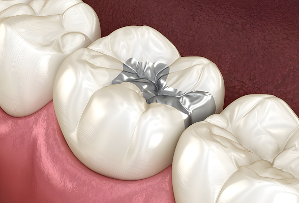 A durable tooth colored fillings