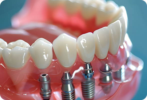 Durable Dental Implants inserted into the jawbone
