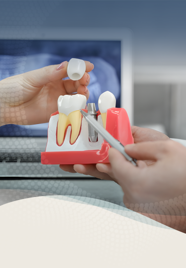 Durable Dental Implants inserted into the jawbone