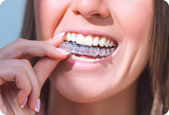 Discreet clear aligners in Hialeah 