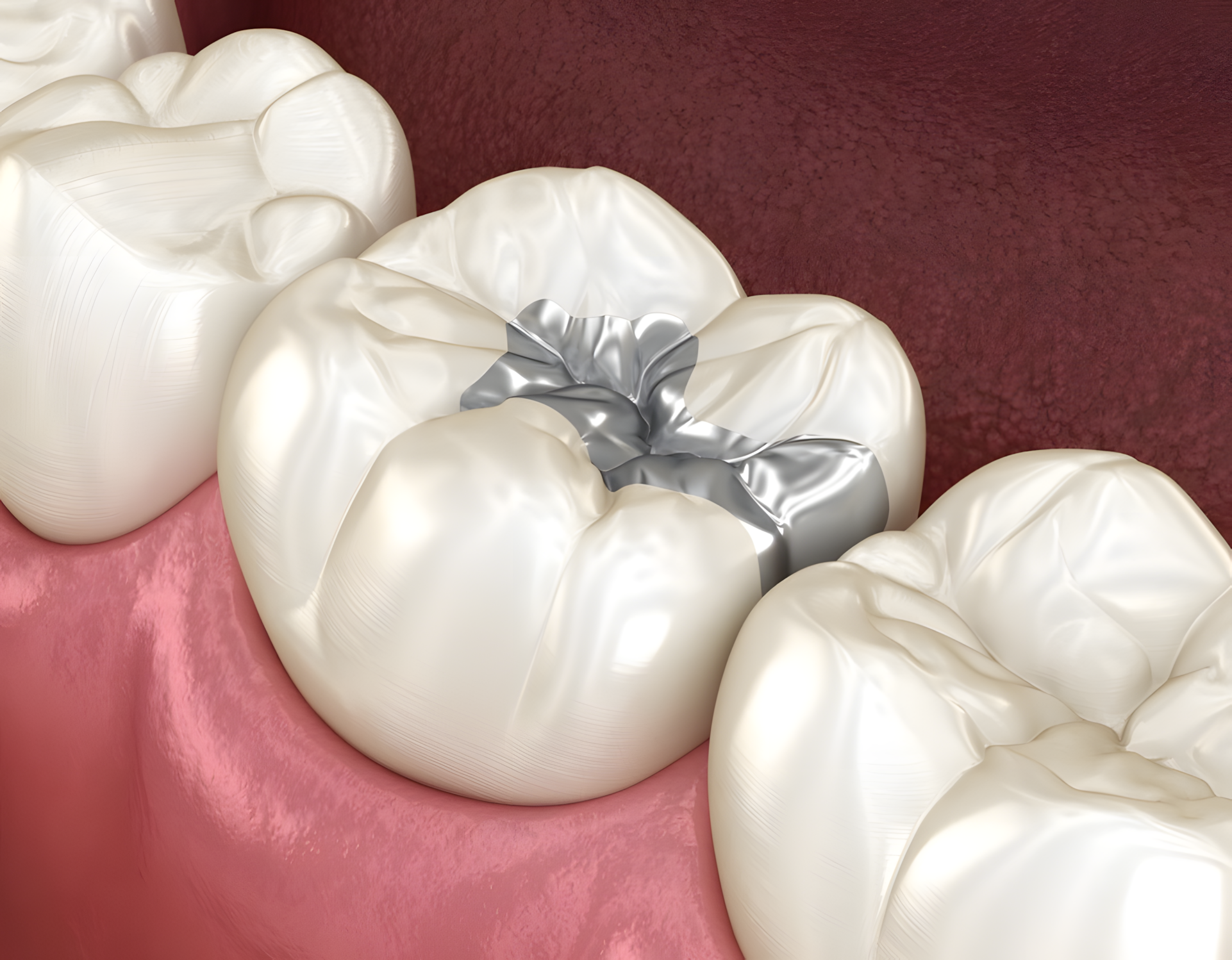 A durable tooth colored fillings