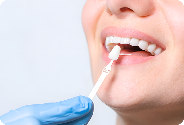 Natural and stunning porcelain veneers