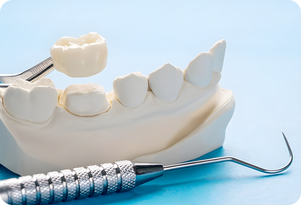 Custom-made Dental Crowns