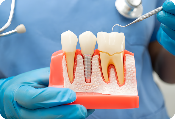 Durable Dental Implants inserted into the jawbone