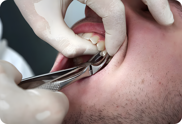 Tooth extraction is the removal of a tooth from its socket in the jawbone, performed by a dentist or oral surgeon using local anesthesia to alleviate pain from decay, infection, or overcrowding.