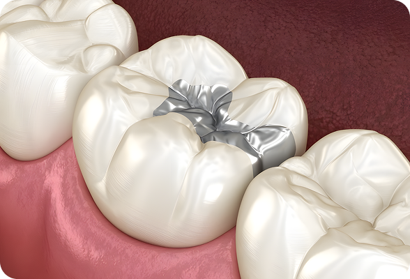 A durable tooth colored fillings