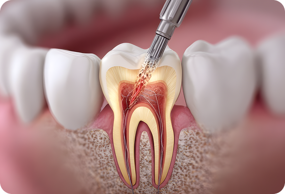  a common, often painless procedure that saves severely damaged or infected teeth by removing diseased pulp, cleaning the canals, and sealing them.