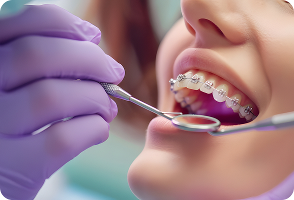 Discreet clear aligners in Hialeah 