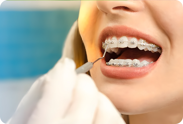 Discreet clear aligners in Hialeah 