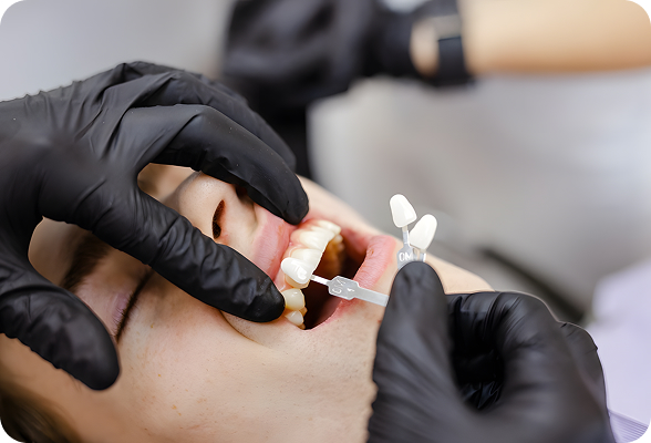 Natural and stunning porcelain veneers