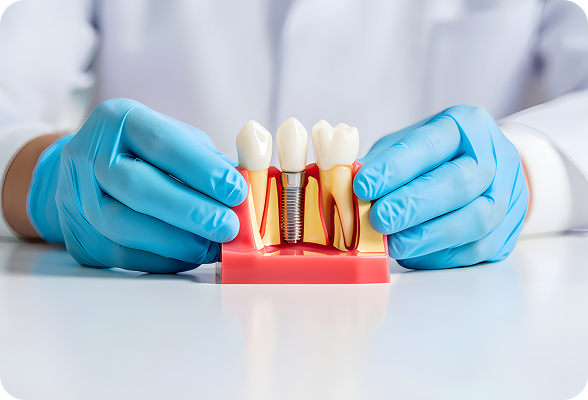 A fixed dental bridge 